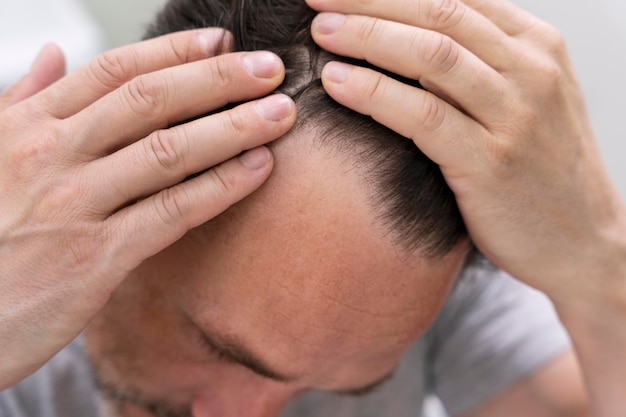 Free photo mature man having balding problems