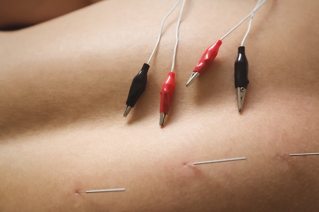 Free Photo mid section of a patient getting electro dry needling on his back