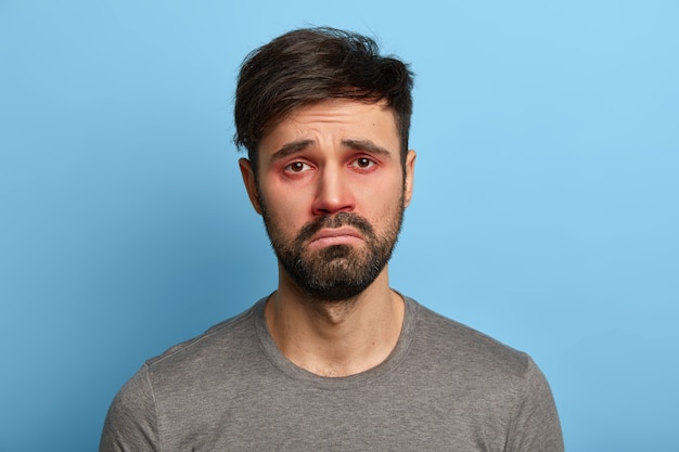 Miserable displeased man has sick look, red swollen eyes, smirks face, suffers from conjunctivitis, seasonal allergy, poses against blue wall. People, disease, health problems concept.