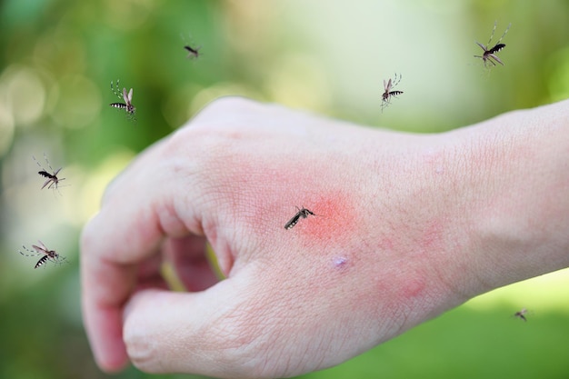 蚊​に​刺された​大人​の​手​による​皮膚​の​発疹​と​赤い​斑点​の​ある​アレルギー