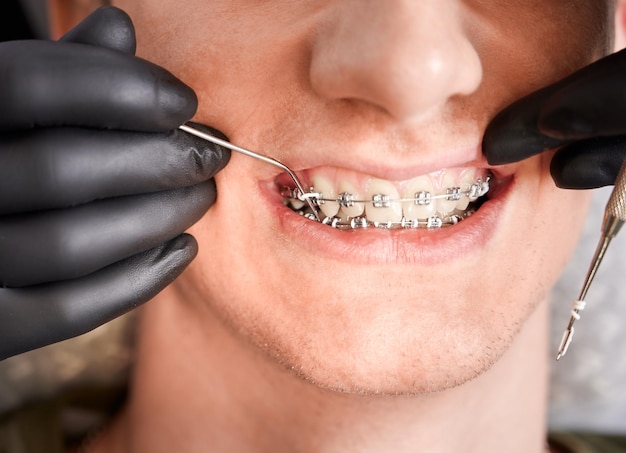 Orthodontist placing rubber bands on male patient braces