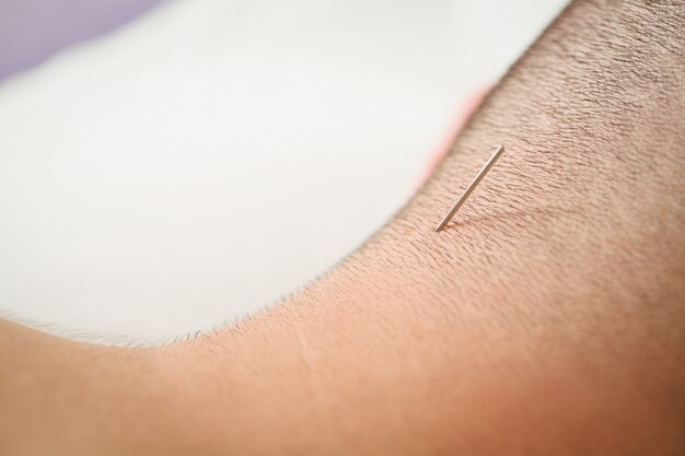 Patient getting dry needling on neck