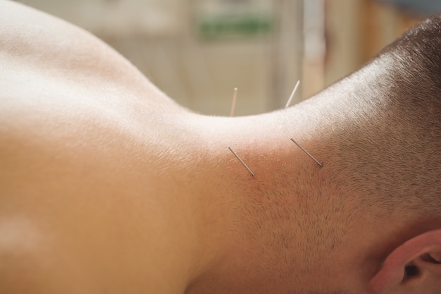 Patient getting dry needling on neck