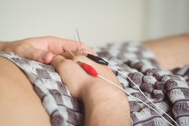 Free photo patient getting electro dry needling on hand