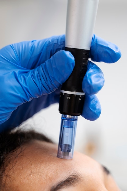 Patient undergoing microneedling procedure