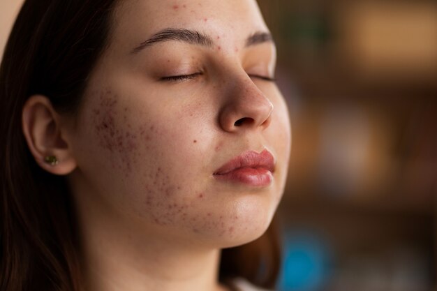 person dealing with rosacea