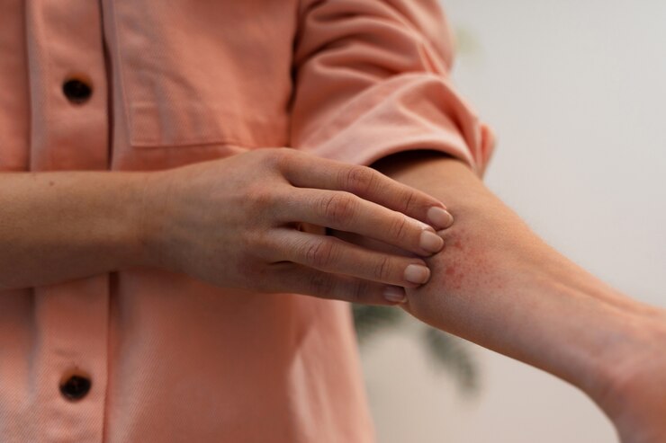 Bed Bug Bites
