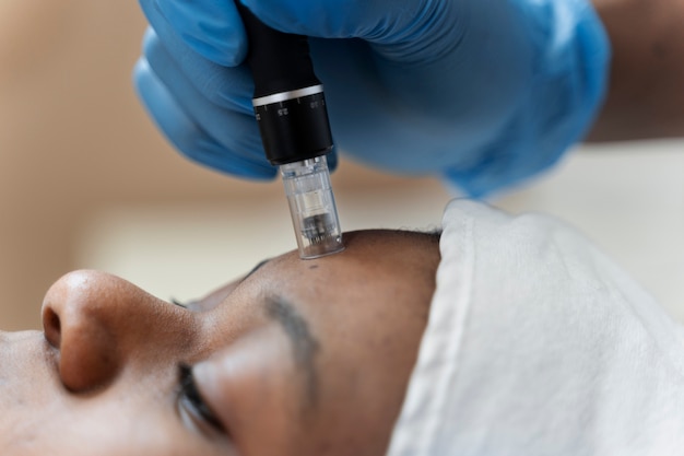 Person getting micro needling beauty treatment