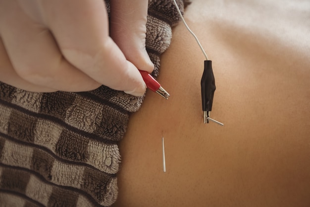 Free photo physiotherapist performing electro dry needling on patient