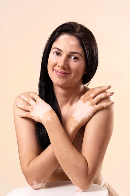 Portrait of beautiful woman with vitiligo