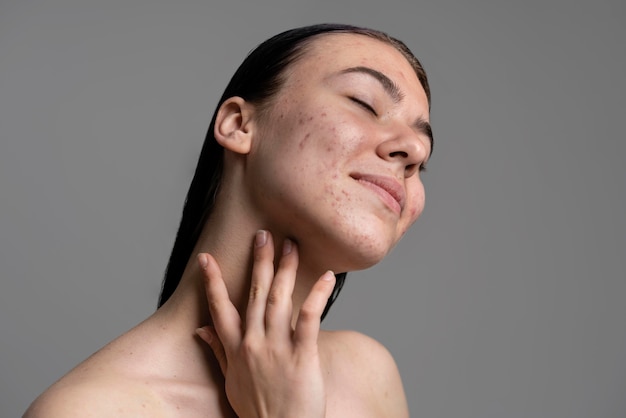 Portrait of beautiful young woman with acne