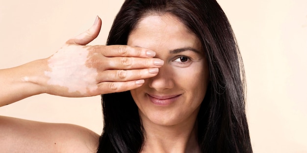 Portrait of confident woman with vitiligo