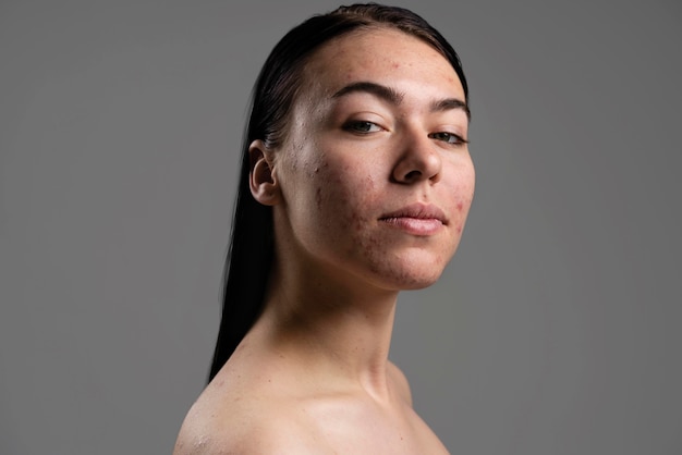 Portrait of confident young woman with acne