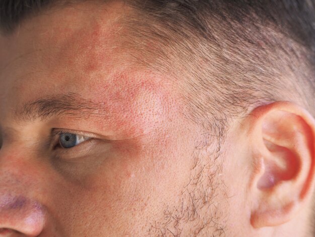 Portrait of a man with stung by a wasp in the forehead | Premium Photo