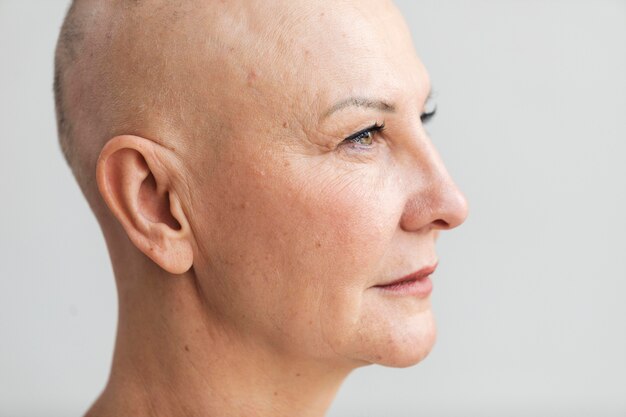 Portrait of woman with skin cancer