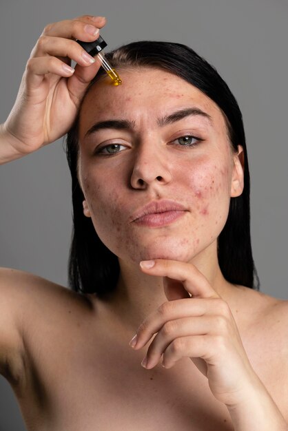 Portrait of young woman being confident with acne