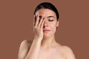 Free photo portrait of young woman being confident with her acne