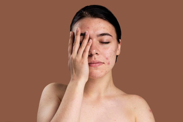 Portrait of young woman being confident with her acne