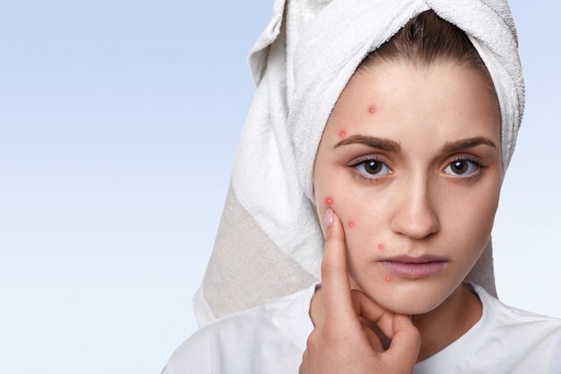 Free photo portrait of young woman having problem skin and pimple on her cheek, wearing towel on her head having sad expression pointing