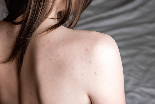 問題​の​ある​肌​。​にきび​、​にきび​、​赤い​斑点​の​ある​若い​女性​の​背中​。