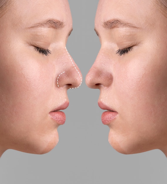 Rhinoplasty surgery concept with  woman model