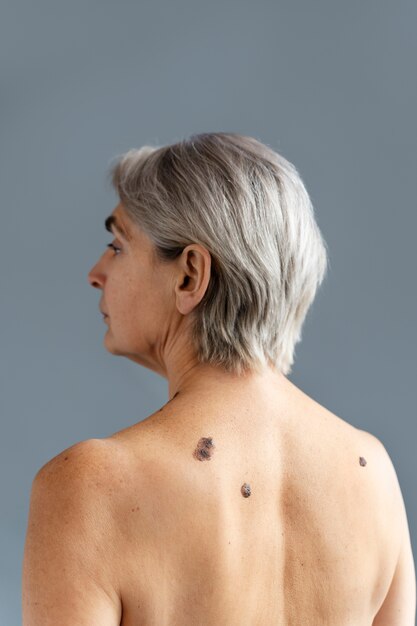 黒色腫の背面図を持つ年配の女性