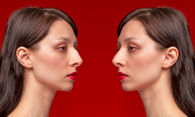 Free photo side view woman before and after rhinoplasty