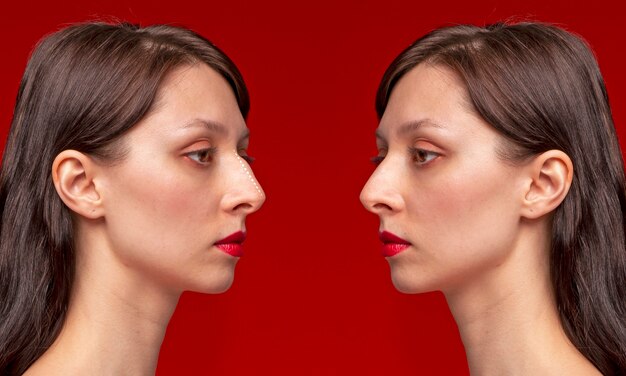 Side view woman before and after rhinoplasty