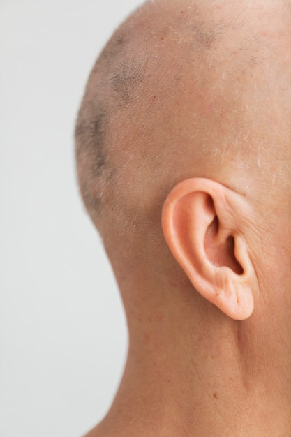 side view woman with skin cancer