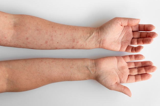 Skin allergy on a person's arms