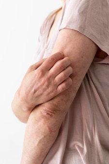 사람의 팔에 대한 피부 알레르기 반응