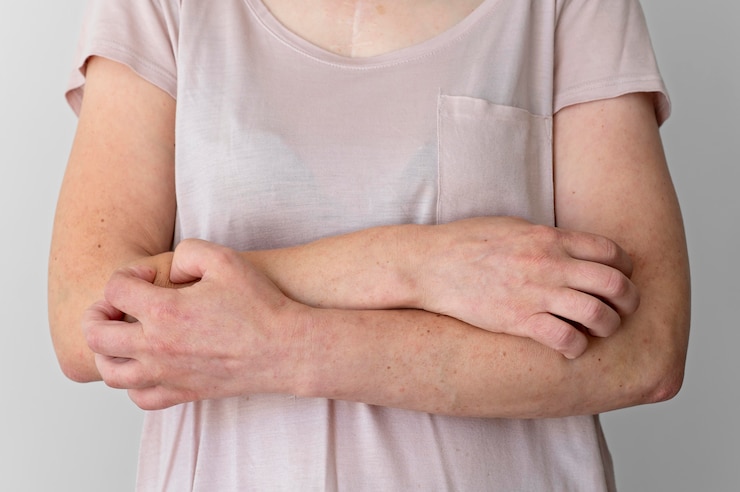 hiperkeratosis