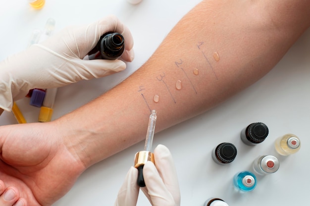 Skin allergy reaction test on a person's arm