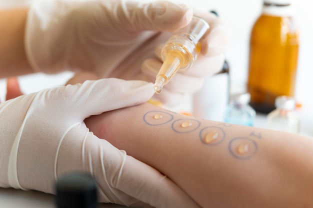 skin allergy reaction test on a person's arm