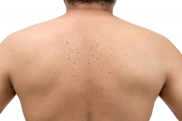 skin tags all over neck