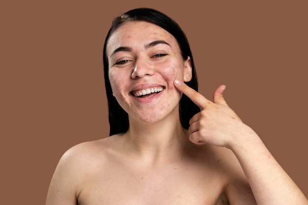 Smiley woman showing her acne with confidence