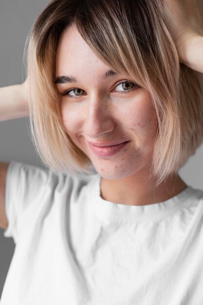 Smiley woman with acne posing