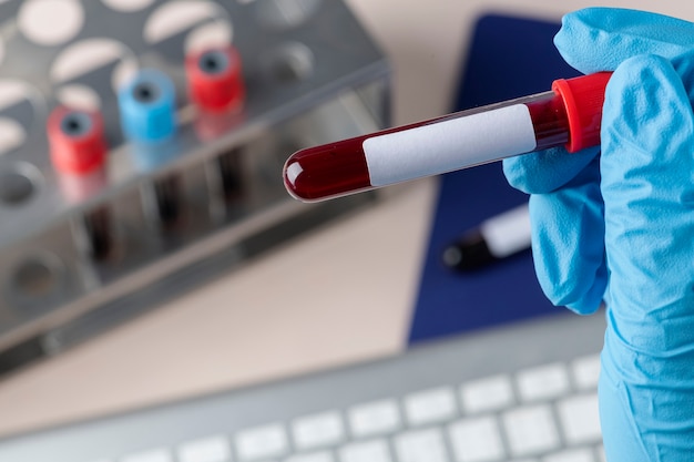 Free photo surgeon holding a blood test