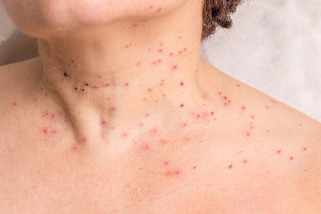 Papilloma colli on neck, Papilloma in neck, Papilloma virus neck