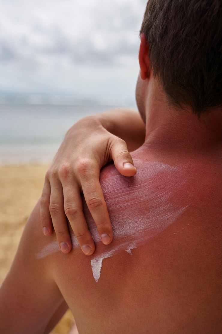 Free Photo view of man applying lotion on sunburn skin at the beach