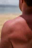 Free photo view of man with sunburn skin at the beach