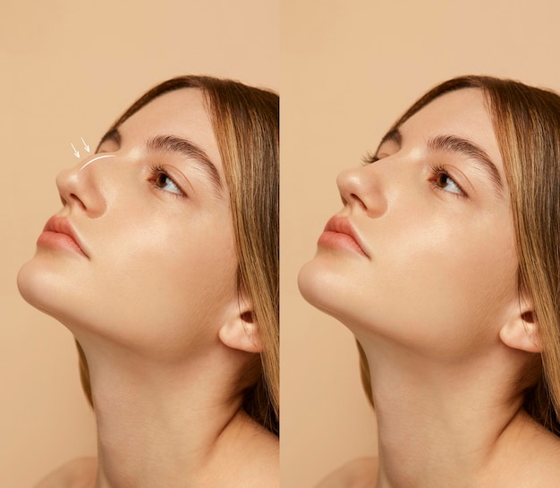 woman getting ready for nose job surgery