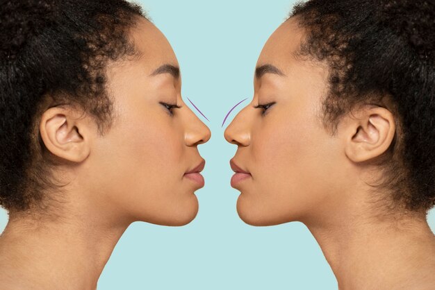 Woman getting ready for nose job surgery