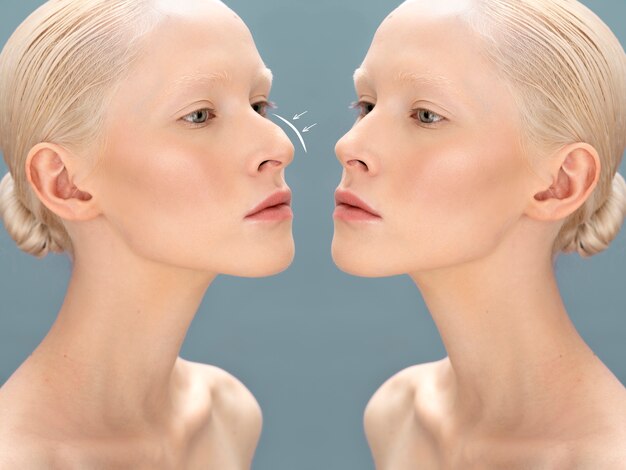 Woman getting ready for nose job surgery