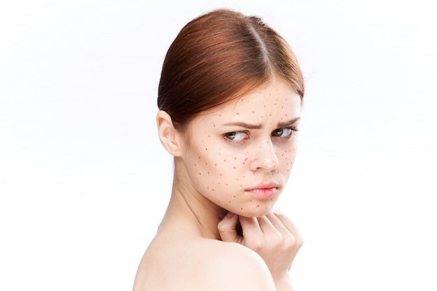 Premium Photo | Woman rash and inflammation of the face, acne and chickenpox