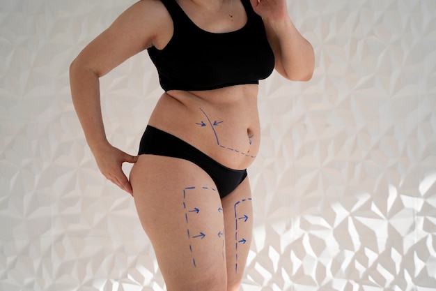 Woman's body with marker traces side view