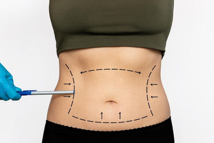 Lipo Cavitation Cost  Beverly Hills Med Spa