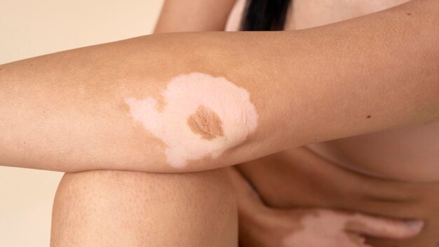 그녀의 vitiligo 피부 부분을 보여주는 여자