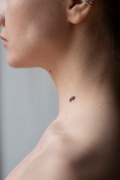 Woman with melanoma on her skin