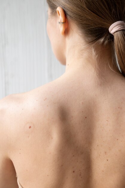 Woman with melanoma on her skin
